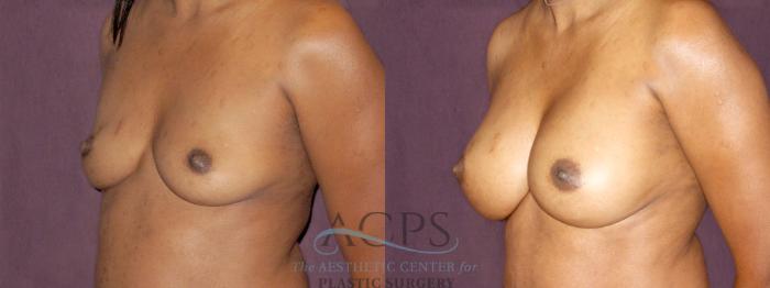 Before & After Breast Augmentation Case 890 Oblique Left View: View in Houston, TX