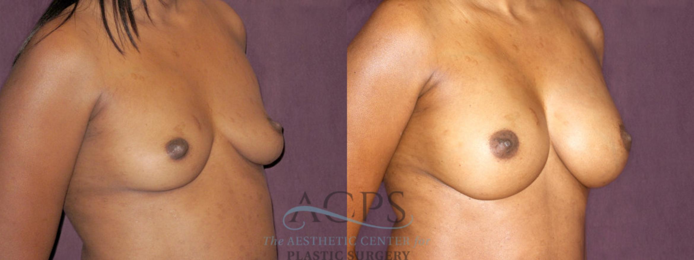 Before & After Breast Augmentation Case 890 Oblique Right View: View in Houston, TX