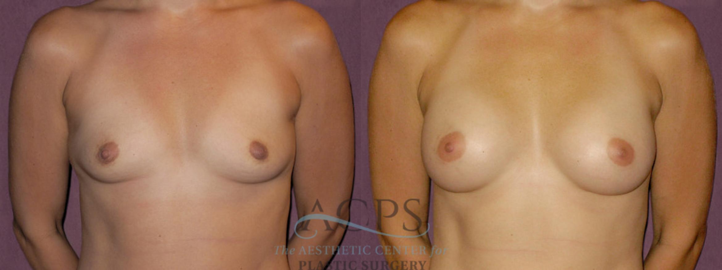 Before & After Breast Augmentation Case 891 Front View: View in Houston, TX