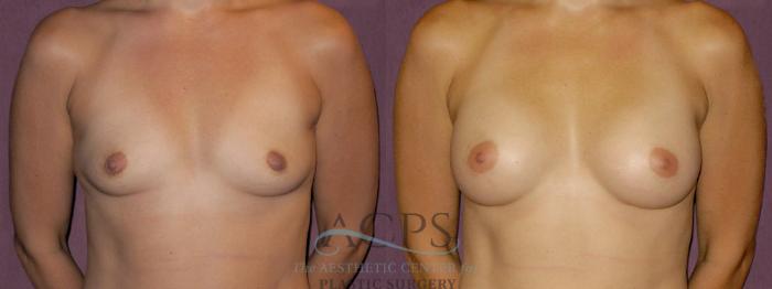 Before & After Breast Augmentation Case 891 Front View: View in Houston, TX