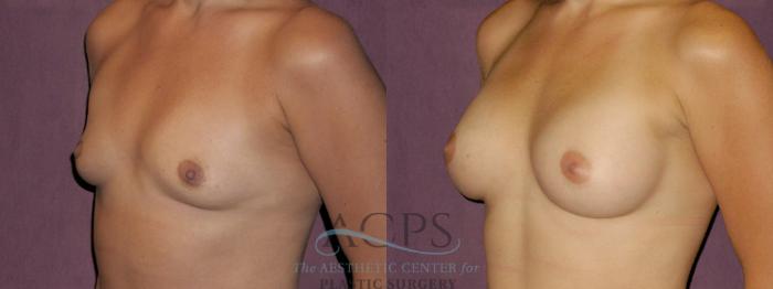 Before & After Breast Augmentation Case 891 Oblique Left View: View in Houston, TX