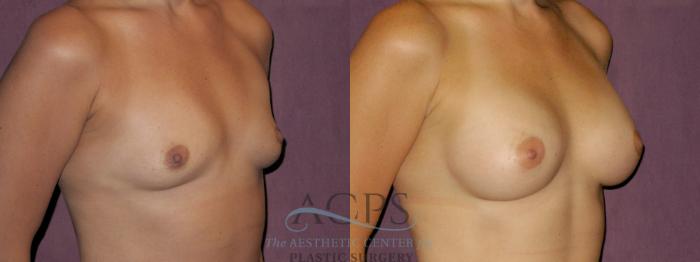 Before & After Breast Augmentation Case 891 Oblique Right View: View in Houston, TX