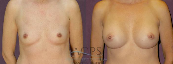 Before & After Breast Augmentation Case 892 Front View: View in Houston, TX
