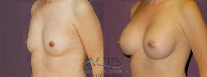 Before & After Breast Augmentation Case 892 Oblique Left View: View in Houston, TX