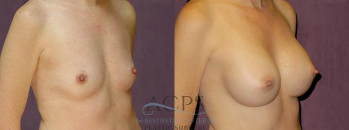 Before & After Breast Augmentation Case 892 Oblique Right View: View in Houston, TX