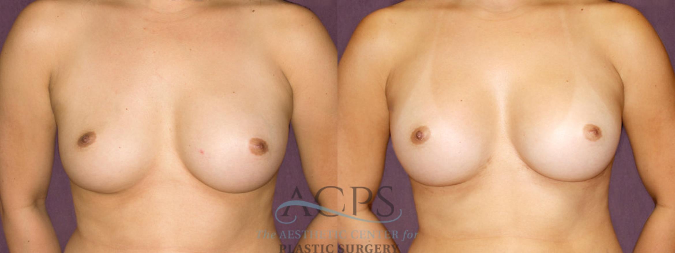 Before & After Breast Augmentation Case 893 Front View: View in Houston, TX