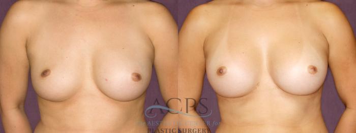 Before & After Breast Augmentation Case 893 Front View: View in Houston, TX