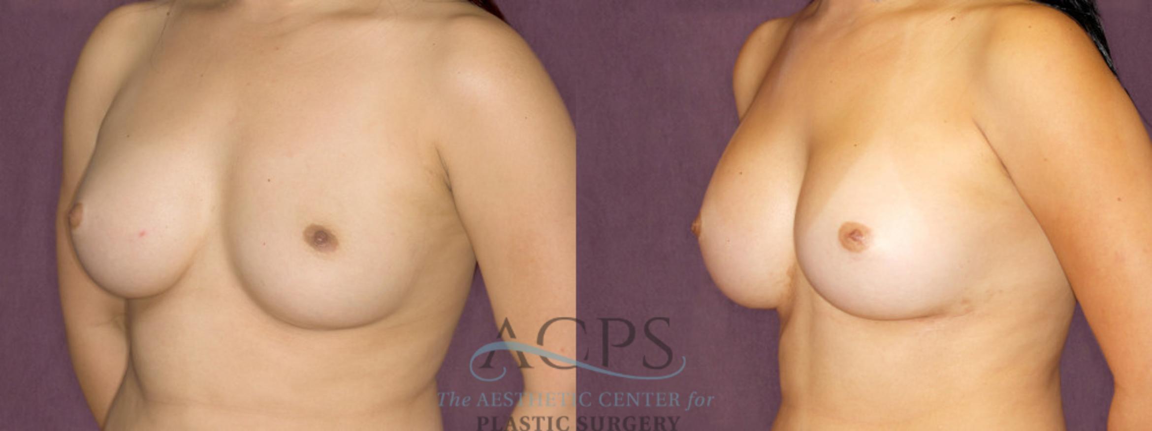 Before & After Breast Augmentation Case 893 Oblique Left View: View in Houston, TX