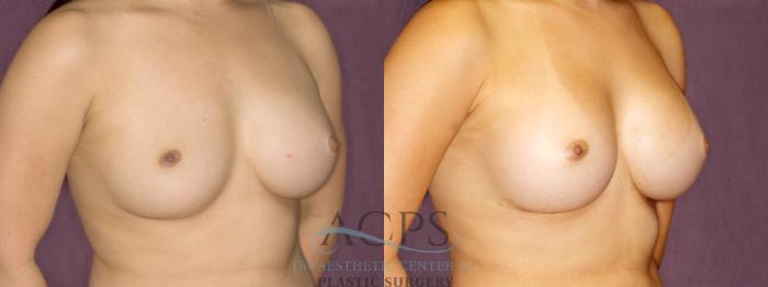 Before & After Breast Augmentation Case 893 Oblique Right View: View in Houston, TX