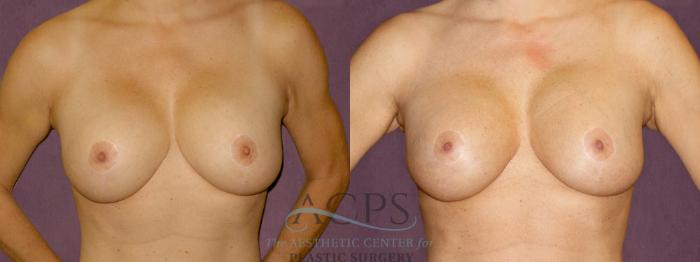Before & After Breast Augmentation Case 894 Front View: View in Houston, TX