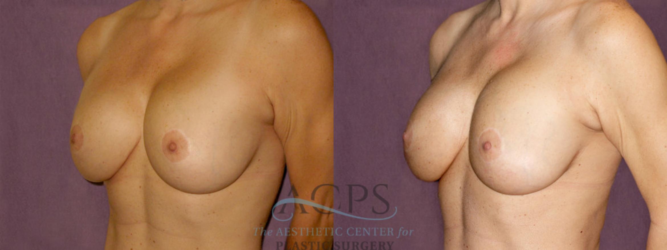 Before & After Breast Augmentation Case 894 Oblique Left View: View in Houston, TX