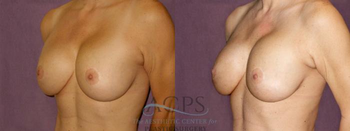Before & After Breast Augmentation Case 894 Oblique Left View: View in Houston, TX
