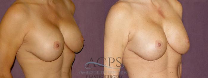 Before & After Breast Augmentation Case 894 Oblique Right View: View in Houston, TX