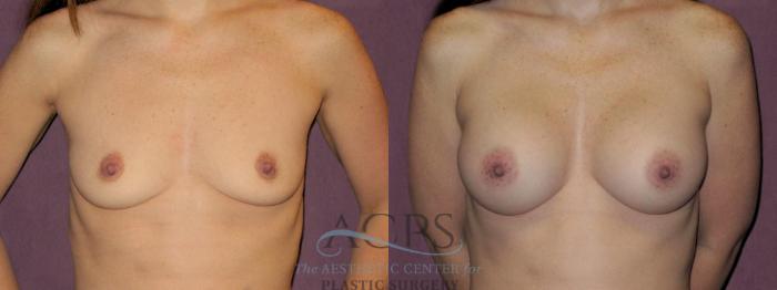 Before & After Breast Augmentation Case 895 Front View: View in Houston, TX