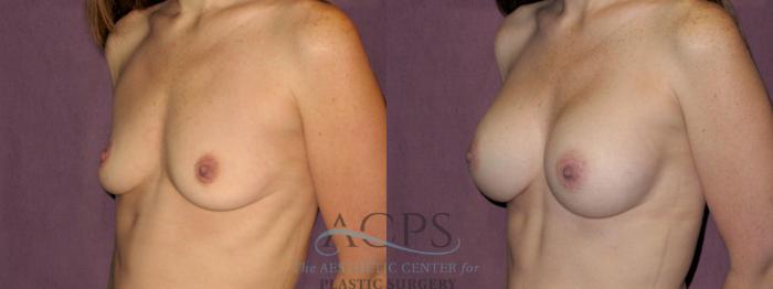 Before & After Breast Augmentation Case 895 Oblique Left View: View in Houston, TX