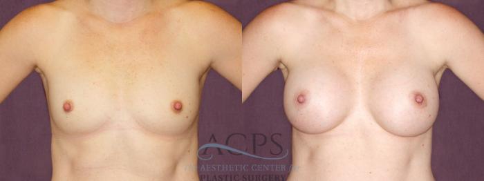 Before & After Breast Augmentation Case 896 Front View: View in Houston, TX