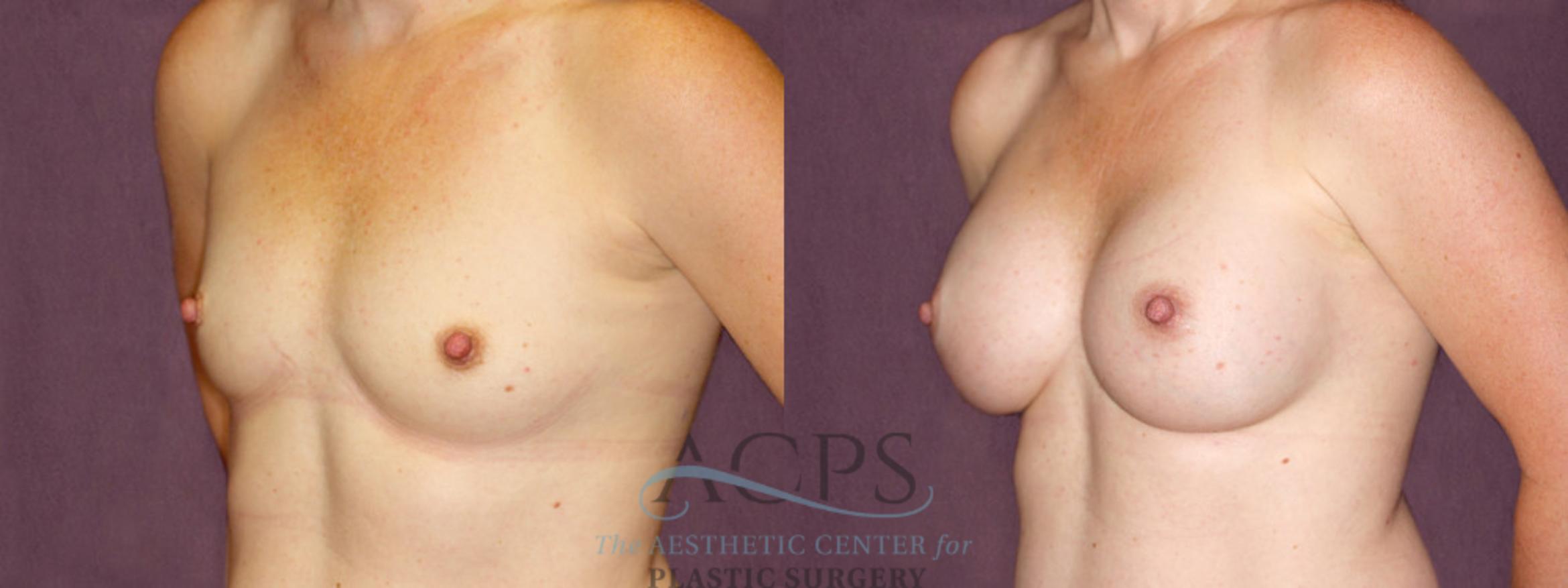 Before & After Breast Augmentation Case 896 Oblique Left View: View in Houston, TX