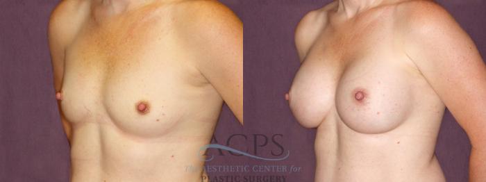Before & After Breast Augmentation Case 896 Oblique Left View: View in Houston, TX