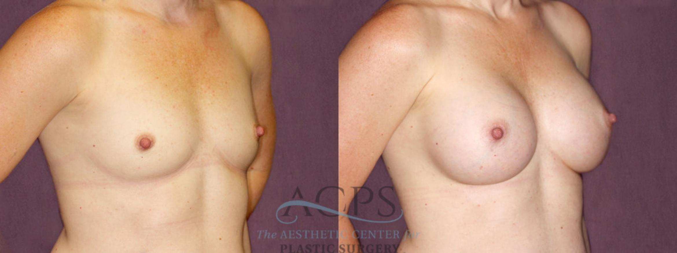 Before & After Breast Augmentation Case 896 Oblique Right View: View in Houston, TX