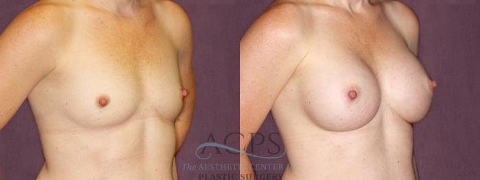 Before & After Breast Augmentation Case 896 Oblique Right View: View in Houston, TX