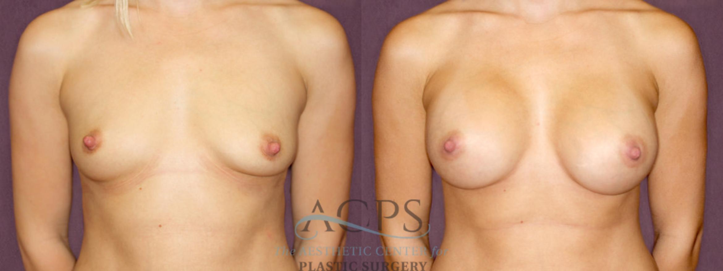 Before & After Breast Augmentation Case 897 Front View: View in Houston, TX