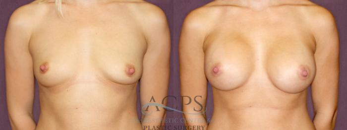 Before & After Breast Augmentation Case 897 Front View: View in Houston, TX