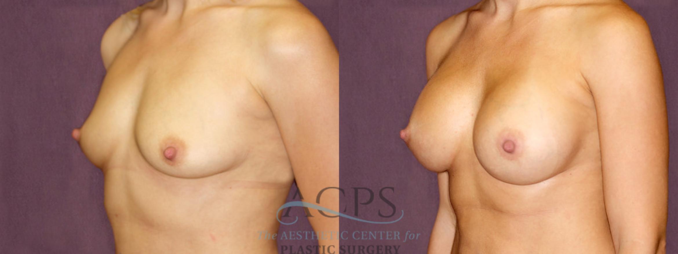 Before & After Breast Augmentation Case 897 Oblique Left View: View in Houston, TX
