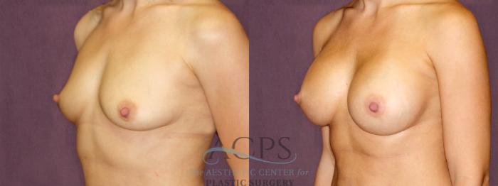 Before & After Breast Augmentation Case 897 Oblique Left View: View in Houston, TX