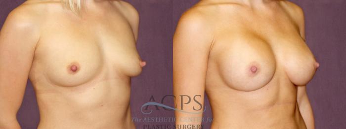 Before & After Breast Augmentation Case 897 Oblique Right View: View in Houston, TX