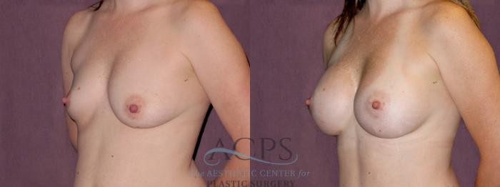 Before & After Breast Augmentation Case 898 Oblique Left View: View in Houston, TX