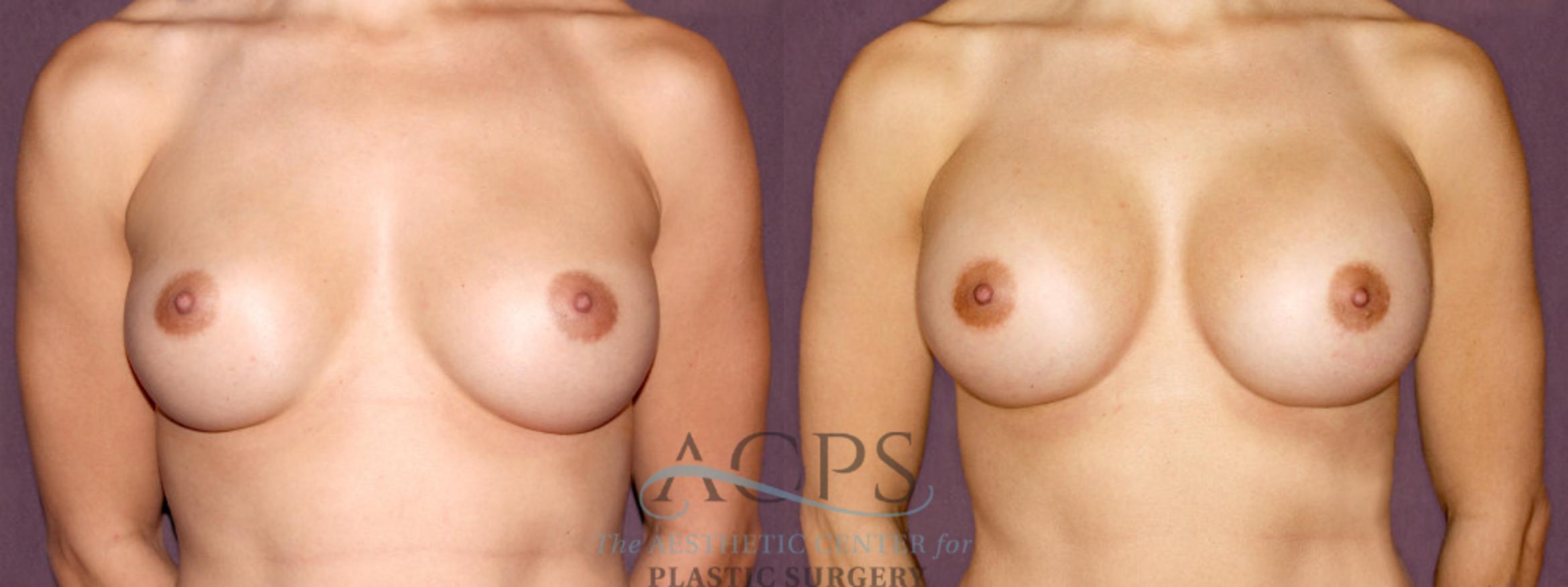Before & After Breast Augmentation Case 899 Front View: View in Houston, TX