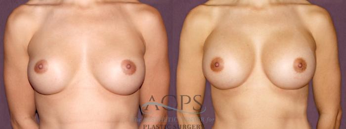 Before & After Breast Augmentation Case 899 Front View: View in Houston, TX