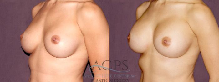 Before & After Breast Augmentation Case 899 Oblique Left View: View in Houston, TX