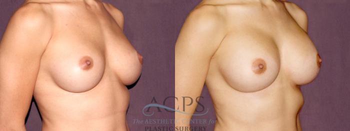 Before & After Breast Augmentation Case 899 Oblique Right View: View in Houston, TX