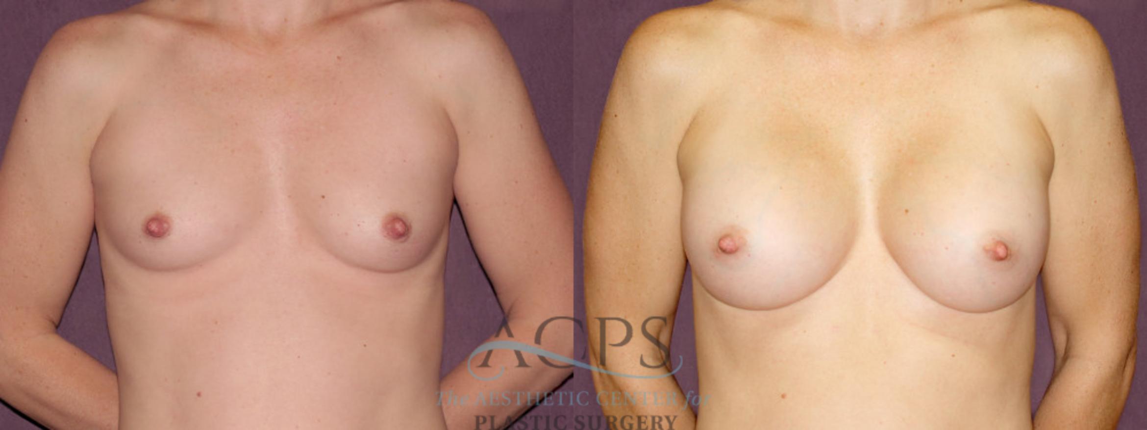 Before & After Breast Augmentation Case 900 Front View: View in Houston, TX