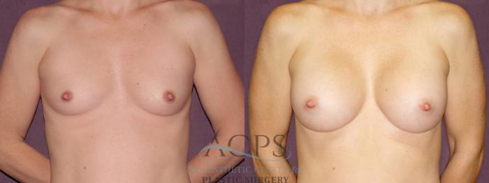 Before & After Breast Augmentation Case 900 Front View: View in Houston, TX