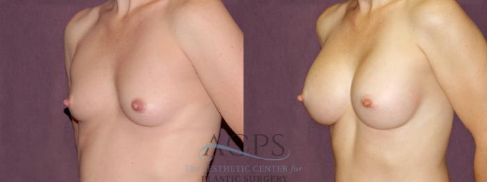 Before & After Breast Augmentation Case 900 Oblique Left View: View in Houston, TX