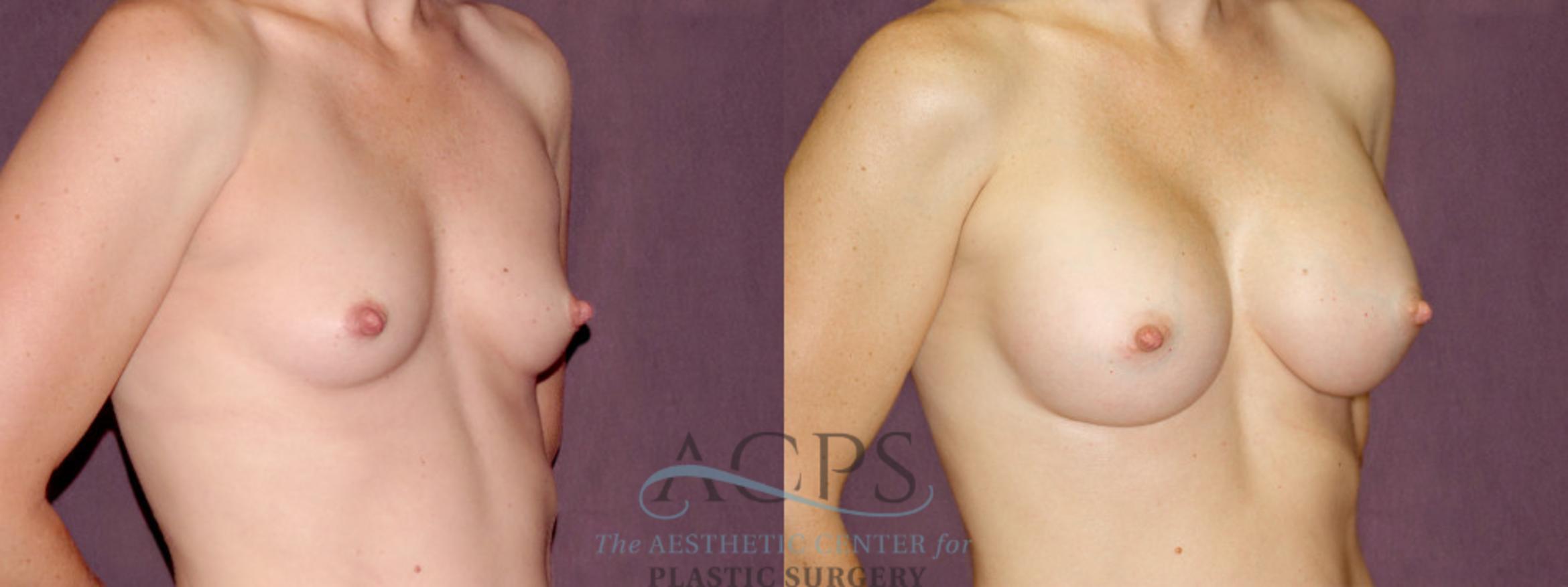 Before & After Breast Augmentation Case 900 Oblique Right View: View in Houston, TX