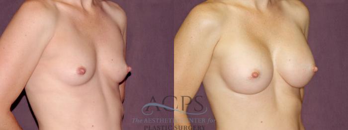 Before & After Breast Augmentation Case 900 Oblique Right View: View in Houston, TX