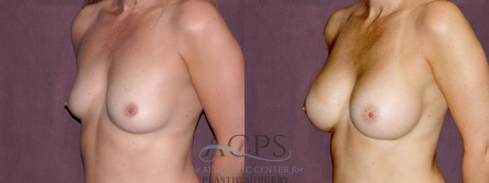 Before & After Breast Augmentation Case 901 Oblique Left View: View in Houston, TX