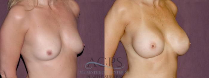 Before & After Breast Augmentation Case 901 Oblique Right View: View in Houston, TX