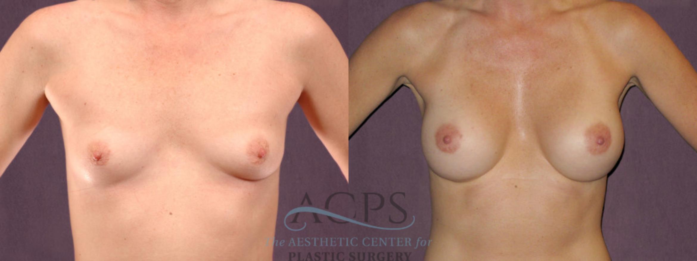 Before & After Breast Augmentation Case 902 Front View: View in Houston, TX