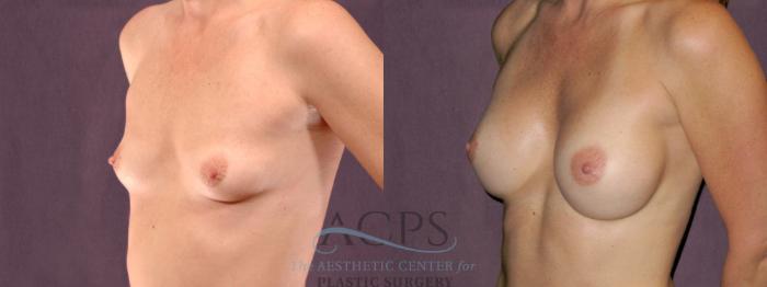 Before & After Breast Augmentation Case 902 Oblique Left View: View in Houston, TX