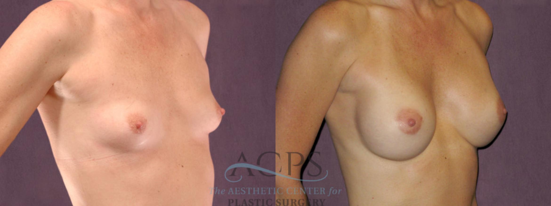 Before & After Breast Augmentation Case 902 Oblique Right View: View in Houston, TX