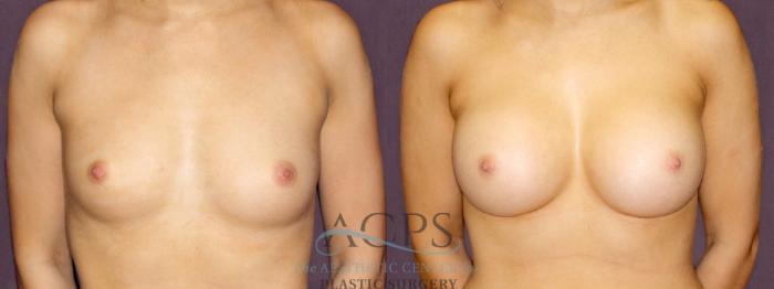 Before & After Breast Augmentation Case 903 Front View: View in Houston, TX
