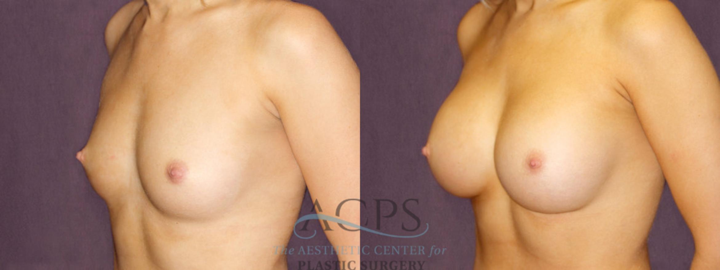 Before & After Breast Augmentation Case 903 Oblique Left View: View in Houston, TX