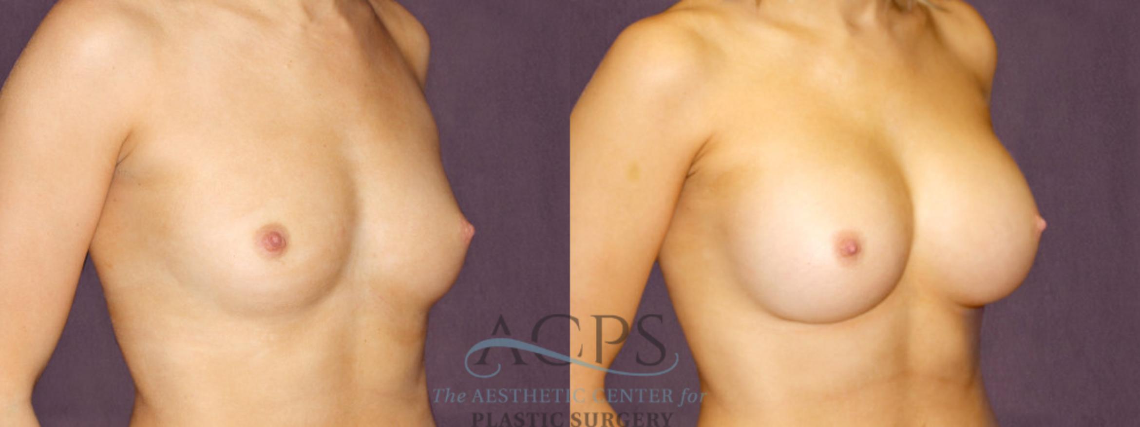 Before & After Breast Augmentation Case 903 Oblique Right View: View in Houston, TX