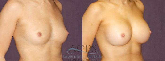 Before & After Breast Augmentation Case 903 Oblique Right View: View in Houston, TX