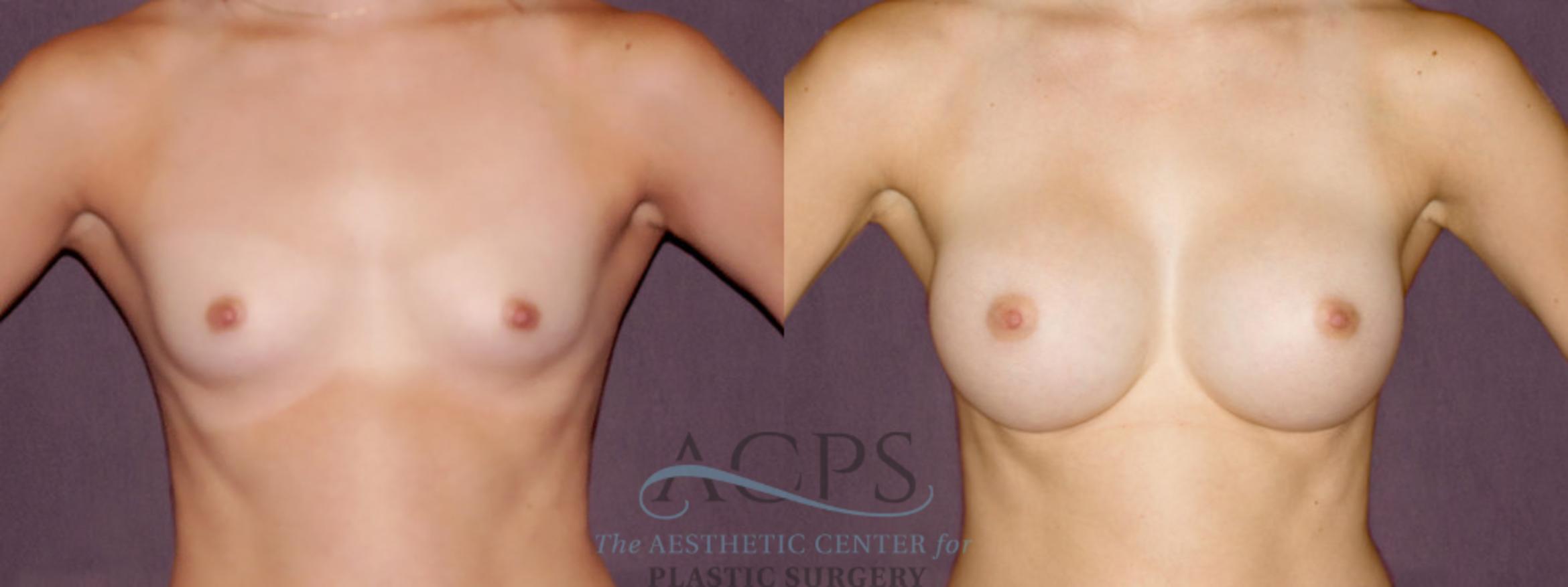 Before & After Breast Augmentation Case 904 Front View: View in Houston, TX
