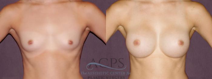 Before & After Breast Augmentation Case 904 Front View: View in Houston, TX